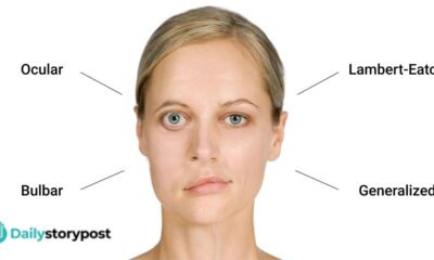 myasthenia gravis
