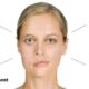 myasthenia gravis